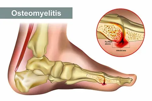 Bone Infections for Columbus, GA | Columbus Foot & Ankle, P.C. | Podiatry, Foot & Ankle Surgeons and Wound Care Specialists