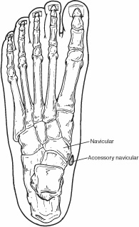 Foot image indicating location of navicular and accessory navicular