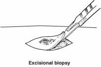Excisional biopsy