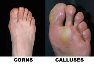 corns-calluses