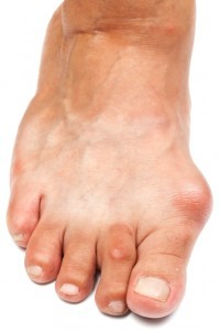 exercises for bunions hammertoes flat feet