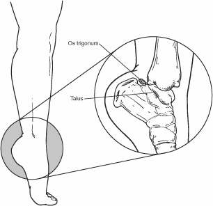 Diagram of Os Trigonum