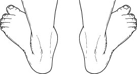 Pediatric flatfoot deformity as seen from the back.